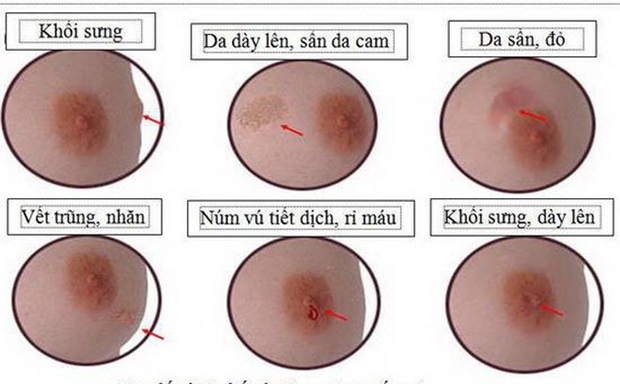 dau-hieu-nhan-biet-som-ung-thu-vu
