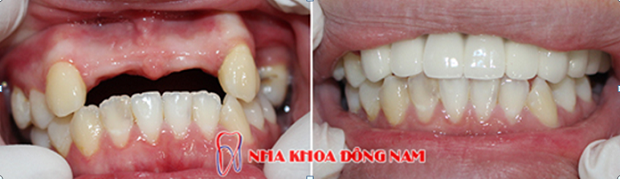 3-cay-ghep-rang