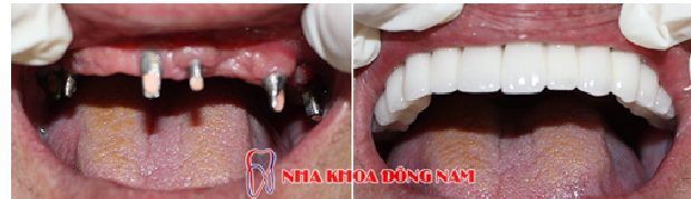 4-cay-ghep-rang