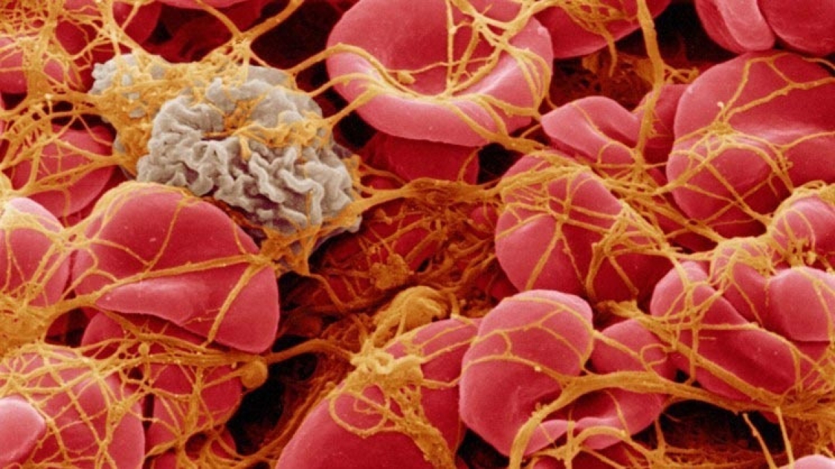 trieu-chung-cach-phat-hien-va-dieu-tri-roi-loan-dong-mau-do-tiem-vaccine-astrazeneca-vhdn
